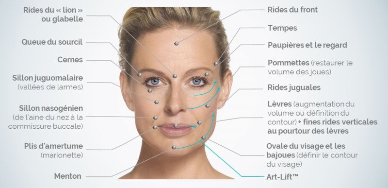 OM Signature - Injection acide hyaluronique -  Clinique Esthétique Médicale Rive-Sud